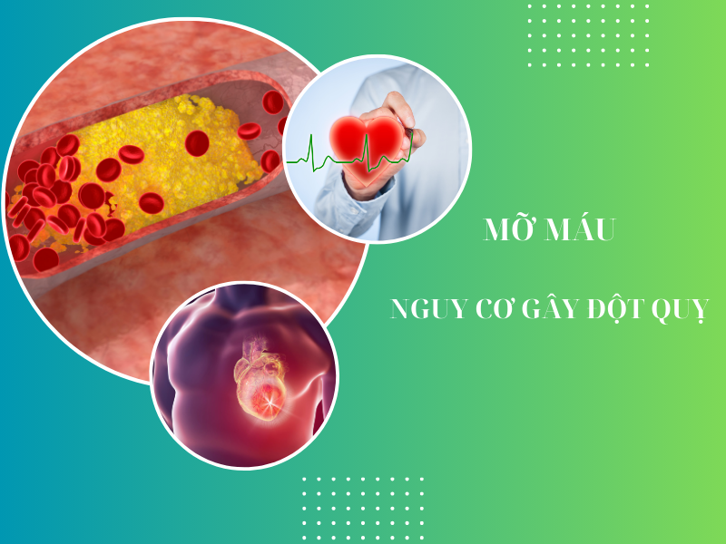 Mỡ máu cao tăng nguy cơ đột quỵ